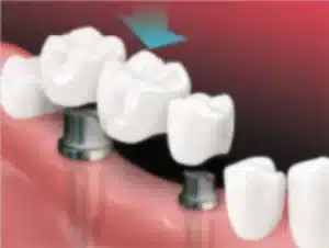Dental Implants Ardmore