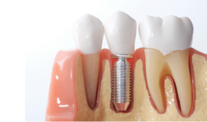 Dental implant cross-section diagram showing tooth structure and metal implant fixture in jawbone model.