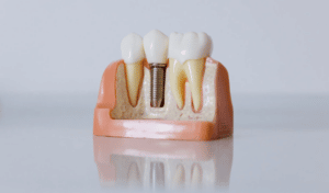 Dental implant model showing tooth replacement stages with crown and artificial tooth on pink base.