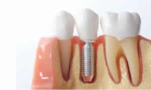 Dental Crowns Ardmore
