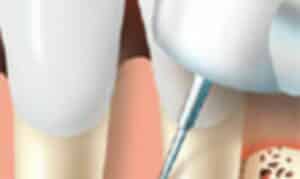 Root Canal Treatment Ardmore