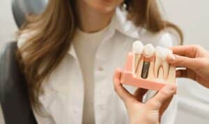 Dental Bridges