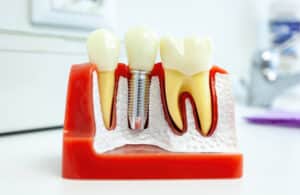 5 Benefits of Dental Implants For A Healthy Smile