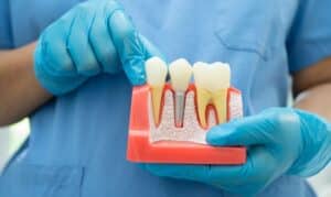 Dental Implants in Ardmore