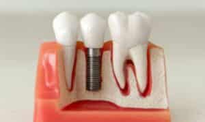 Dental Implants in Ardmore
