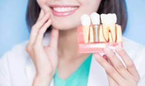 Dental Implants Ardmore