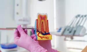 Root Canal Treatment Ardmore