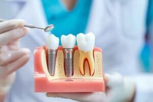 Dental Implants Ardmore