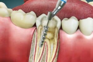 Root Canal Treatment in Ardmore