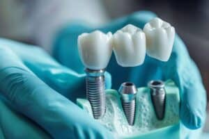 Dental Implants Ardmore