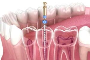 Root Canal Treatment Ardmore