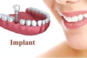 Dental Implants in Ardmore