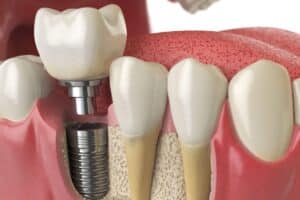 Dental Implants Ardmore