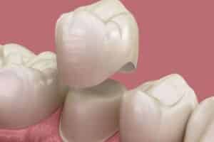 Dental Crowns Ardmore