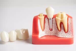Dental Implants in Ardmore