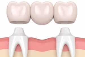 Dental Crowns Ardmore