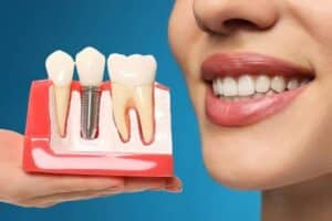 Dental Implants Ardmore
