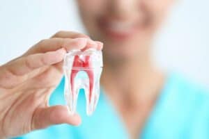 Root Canal Treatment Ardmore