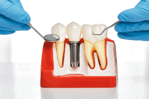 How Dental Implants Can Improve Your Life