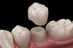 Smile Makeover: Transforming Smiles with Dental Crowns