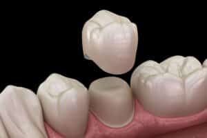 How Long Does a Dental Crown Last?