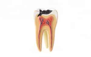 What to Do If a Root Canal Gets Infected