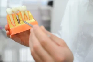 Dental implant replacing a single missing tooth